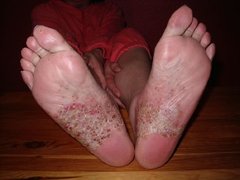 Psoriasis pustulosa an beiden Fußsohlen