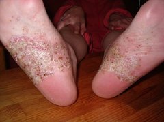 Psoriasis pustulosa