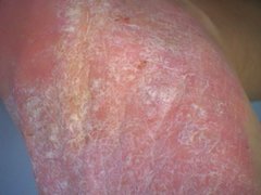 Eine akute Psoriasis am Fuß