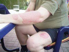 Schuppenflechte-Bilder