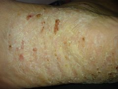 Psoriasis am Fuß