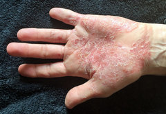 Psoriasis vulgaris palmoplantaris