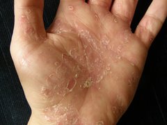 Schuppenflechte an der Handinnenfläche