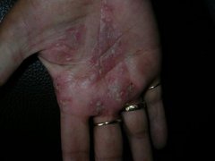 Akute Psoriasis an der Handfläche