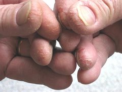 Schuppenflechte an den Fingerkuppen (nachher)