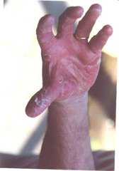 Psoriasis an der Hand