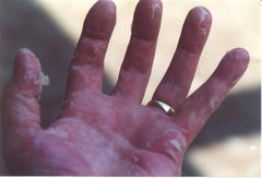 Schuppenflechte in der Hand (nachher)