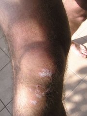 Schuppenflechte am Knie