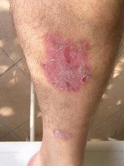 Psoriasis am Schienbein