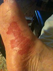 Offene Psoriasis-Stelle