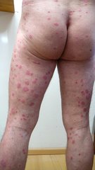 Psoriasis an den Beinen, am Po und am Rücken