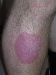 Ein runder Psoriasis-Herd