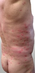 Psoriasis am Oberkörper