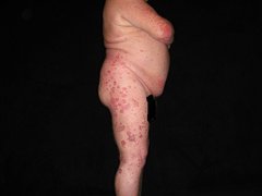 Psoriasis am Körper