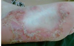 Psoriasis an der Sohle