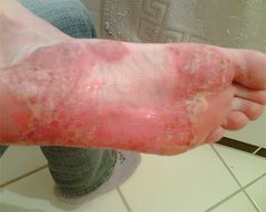 Sohle mit Psoriasis