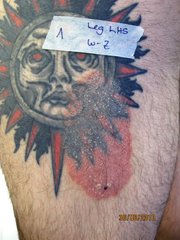 Psoriasis, hervorgerufen durch ein Tattoo