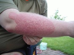 Psoriasis am Unterarm