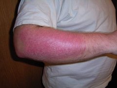 Akute Psoriasis am Unterarm