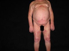 Psoriasis am Körper (Vorderansicht)
