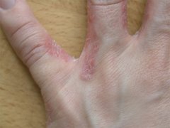 Schuppenflechte zwischen Fingern