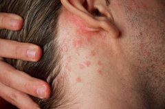 Psoriasis hinter dem Ohr
