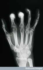 Psoriasis arthritis der Distalphalangealgelenke