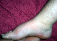 Psoriasis arthritis am Fuß