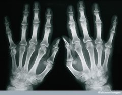 Psoriasis arthritis der Interphalangealgelenke