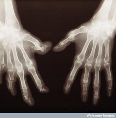 Psoriasis arthritis mutilans