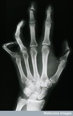 Psoriasis arthritis der Phalangealgelenke