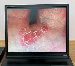 Psoriasis an den Fingern unter dem Mikroskop