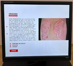Schuppenflechte – Ursachen
