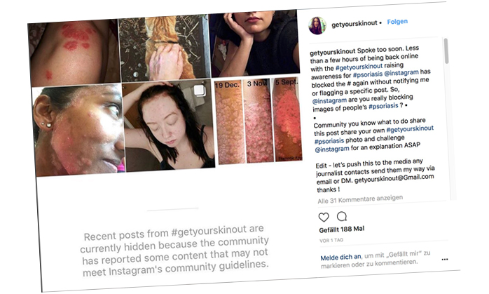 Facebook und Instagram löschen Fotos mit Schuppenflechte