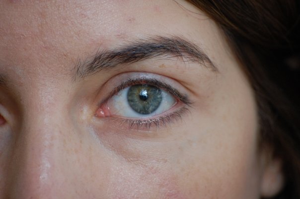 Geschwollene Augen