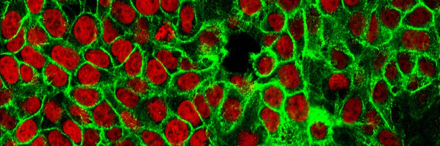 Psoriasis und Krebs – wer hat damit Erfahrung?