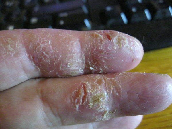 Psoriasis an den Fingern – was tun?