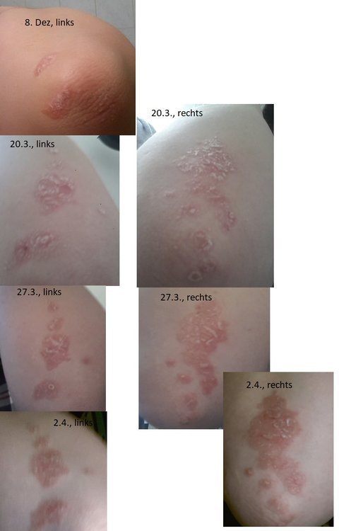 299139589_VerlaufEllbogen.thumb.jpg.536fc14bcbd16b46117c7341cb07e111.jpg