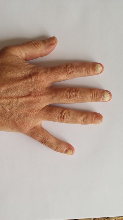 Alle betroffenen Nägel in unterschiedlichen Stadien.jpg