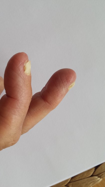 Hautveränderugen rund um den Nagel.jpg