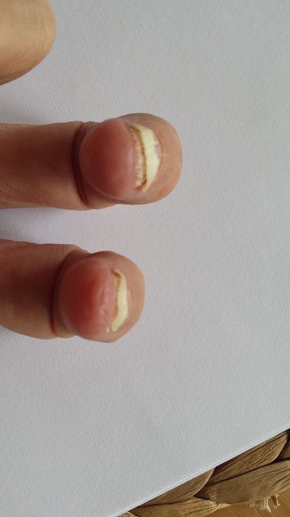 Nagelplatte löst sich und bekommt Dellen.jpg