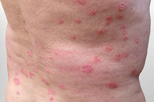 Psoriasis guttata: Symptome, Auslöser, Behandlung...