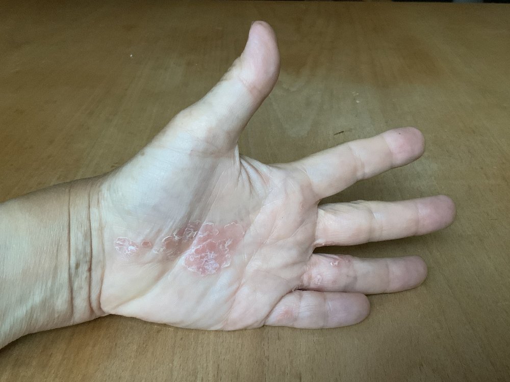 Schuppenflechte linke Hand