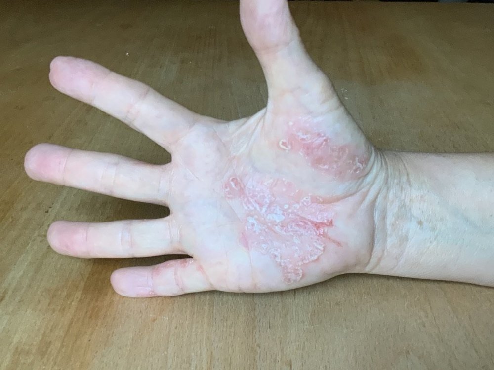 Schuppenflechte rechte Hand