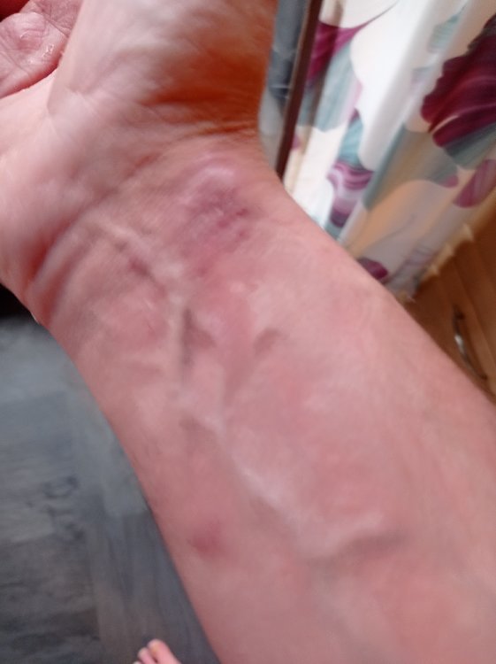 8 Tage später mit Xyndet Shampoo.jpg