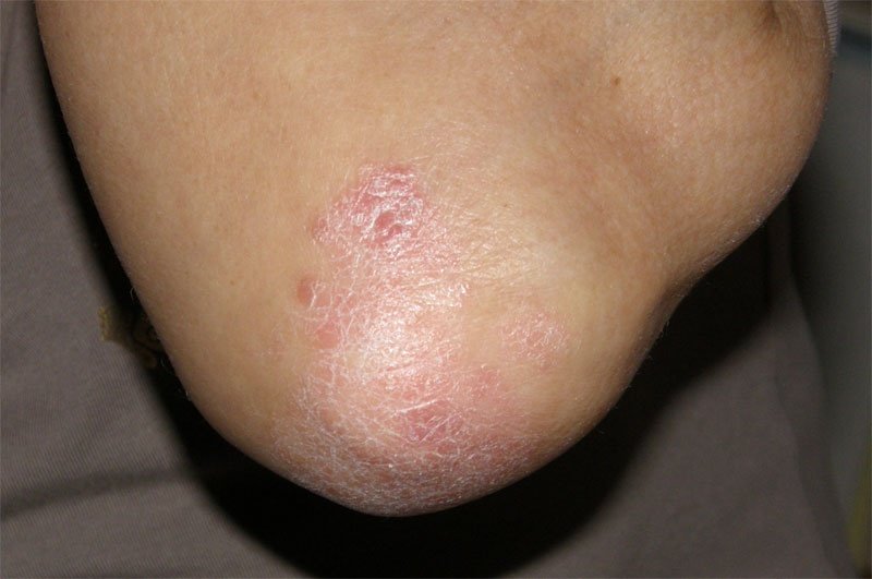 Schuppenflechte (Psoriasis) am Ellbogen
