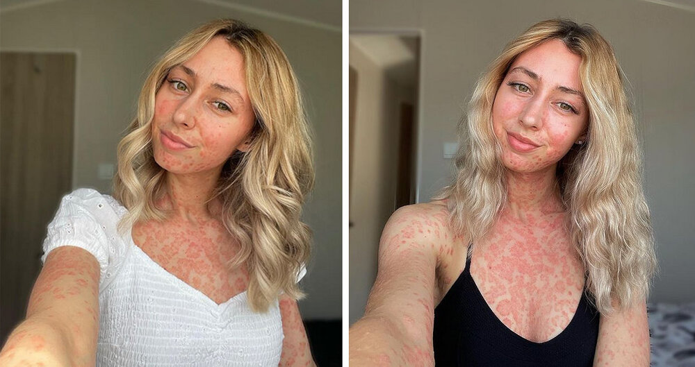 claires-psoriasis.jpg