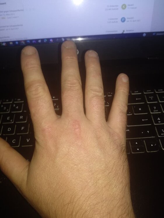 Psoriasis an den Fingern