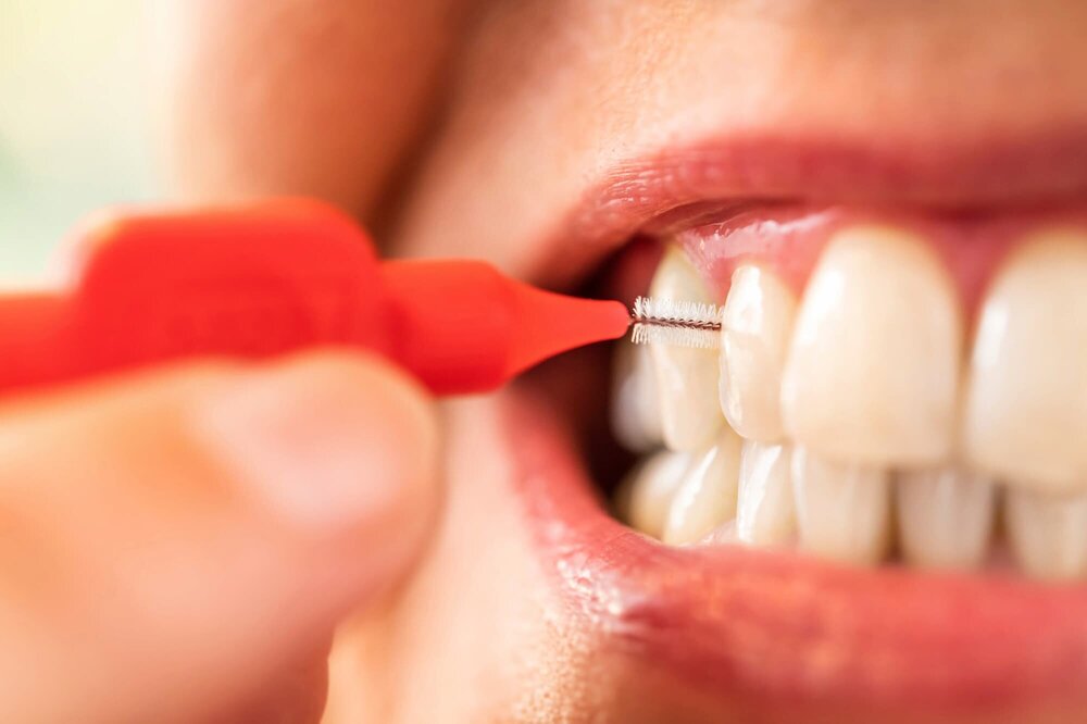 Anwendung einer Interdentalbürse