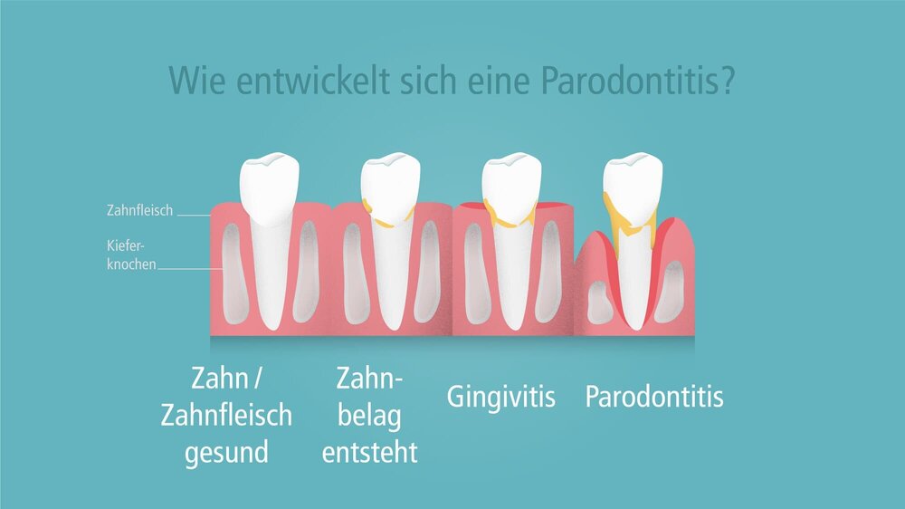 Entwicklung einer Parodontitis